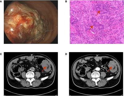 Case report: Successful treatment of advanced colon cancer in an eighty-year-old man with long-term and multi-stage endoscopic minimally invasive therapy